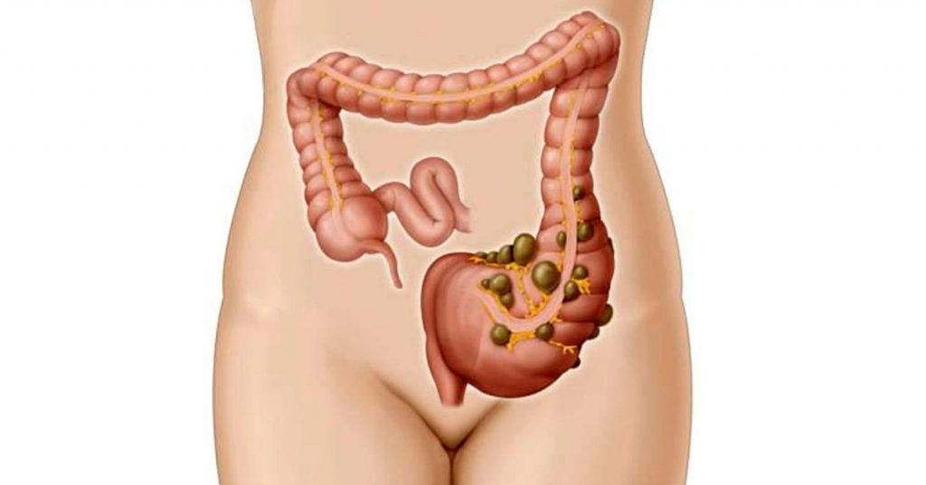 Diverticulosis Foods to Avoid